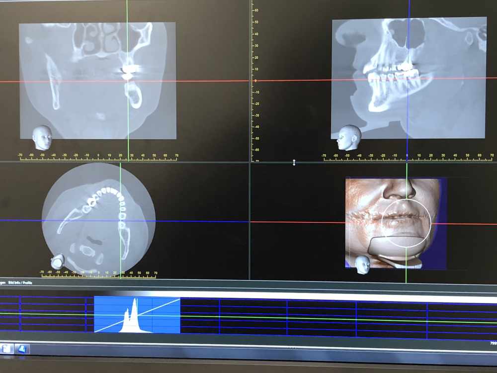 3D Röntgen (DVT) Beispielschnitte bei medi+ zahnärztliche Praxisklinik, MKG-Chirurgie