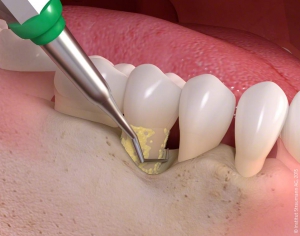 Behandlung von Parodontitis - medi+ - Foto: Straumann